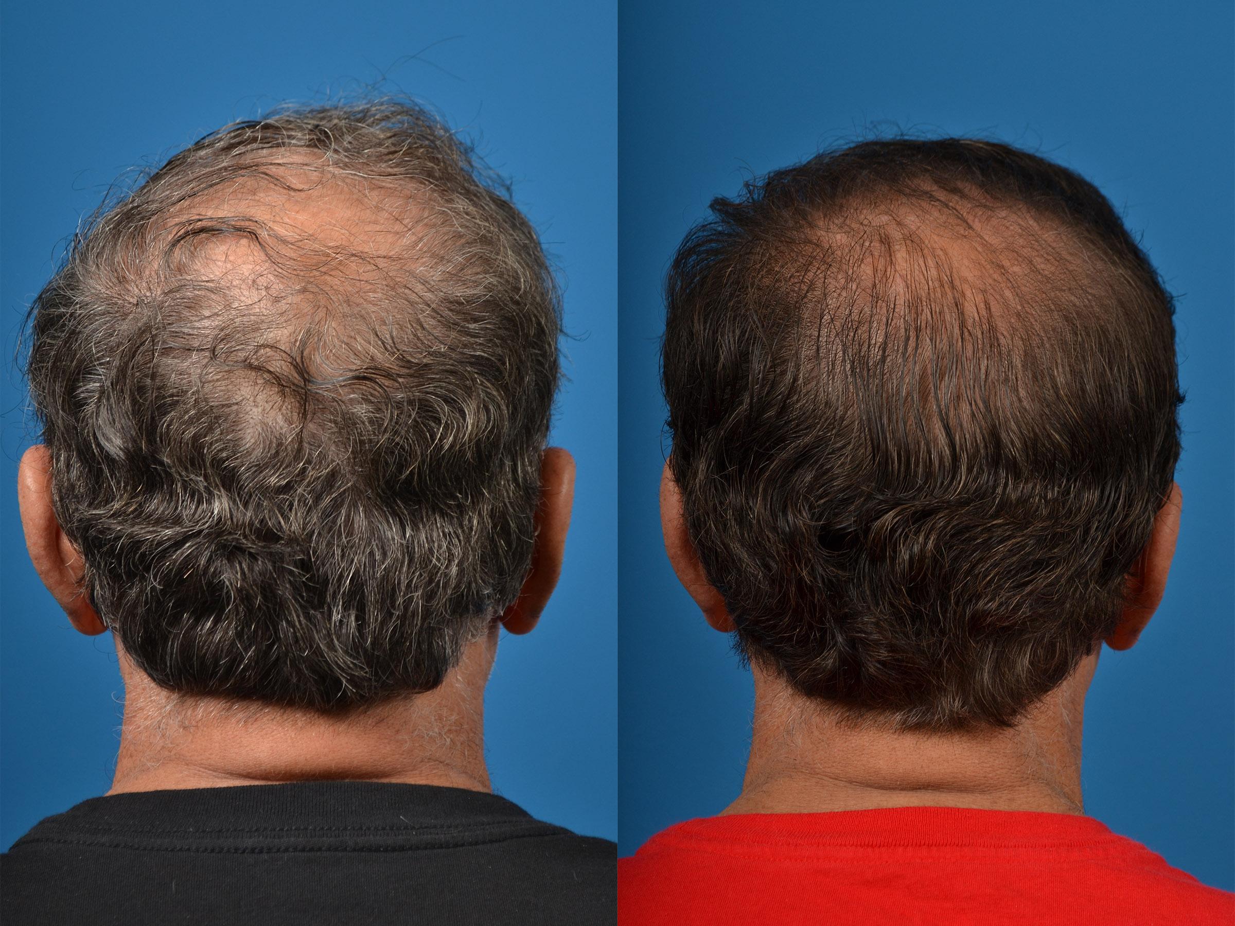 Hair Restoration Photos Melbourne, FL Patient 53714
